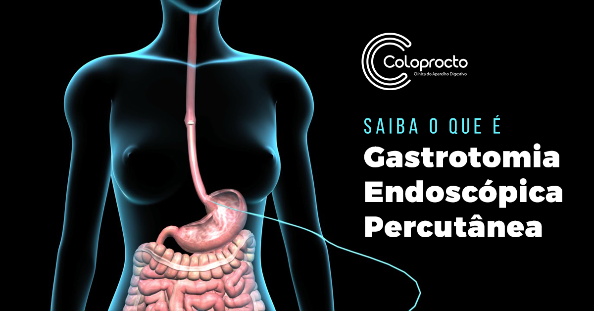 Saiba o que é Gastrostomia Endoscópica Percutânea